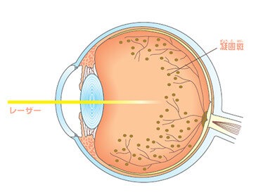 レーザーによる網膜光凝固術